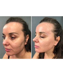 Мікрострумовий ліфтинг Skin Lifting 6.0